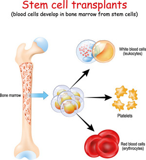 Bei einer Knochenmarktransplantation werden Stammzellen des Knochenmarks entnommen und einem Patienten eingesetzt. Die Stammzellen entwickeln die Zellen des Blutsystems. Der Empfänger trägt die Blutzellen des Spenders in sich und ist deshalb eine Chimäre. Abbildung: designua - stock.adobe.com